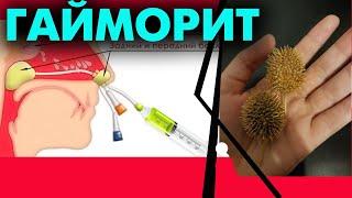 Гайморитті емдеу жолдары / #гайморит