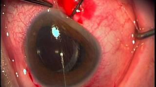 Reposition of multifocal IOL