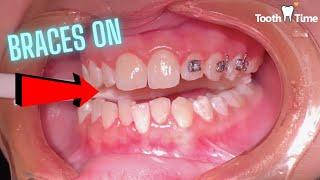 Does it hurt to get braces? - Tooth Time Family Dentistry