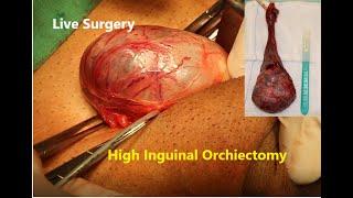 High Inguinal Orchiectomy for Testicular Cancer: Case Presentation and Live Surgery