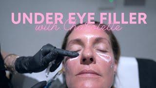 Under Eye Filler Treatment with Dr Nina Bal  Under Eyes Circles Treated with Dermal Filler