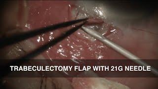 TRABECULECTOMY WITH MM-C