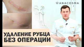️Лазерная шлифовка шрамов ️Лазерное удаление рубцов  ОПАСНО? | Миронов Андрей