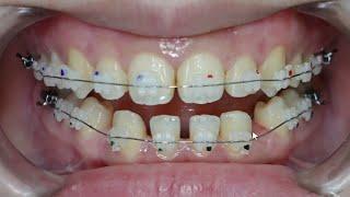 Pemasangan Ceramic Braces | Kawat Gigi | Behel Ceramic