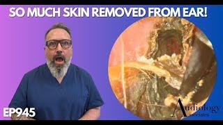 SO MUCH SKIN REMOVED FROM PATIENTS EAR CANAL - EP945