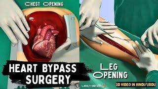 Heart Bypass Surgery ' 3D Video In  हिन्द/اردو