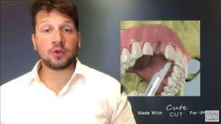 Dr. Victor Hugo Almeida | Passo a Passo Implante Dentário