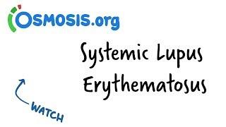 Systemic Lupus Erythematosus | Clinical Presentation