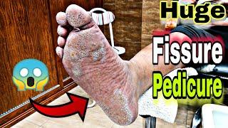 pedicure many small warts Remove huge, Fissure, on the tutorial feet in , | Footcare33