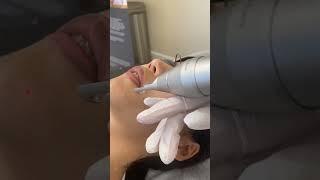 PicoCare treatment at Pure Cell Pasadena Ca