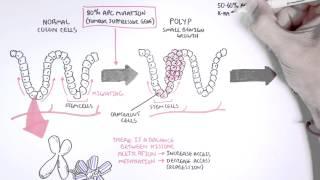 Colon Cancer Carcinogensis