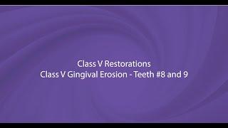 OMNICHROMA Procedure Video with Dr. Kevin Brown: Class V Gingival Erosion, Teeth #8-9