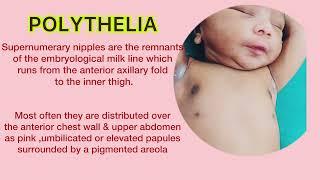 Polythelia.Supernumerary nipple.Accessary nipple.