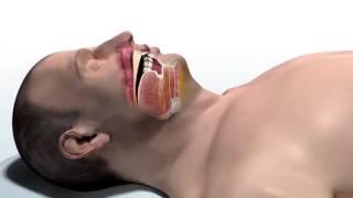 Inspire Therapy for Obstructive Sleep Apnea