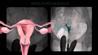 Fallopian Tube Recanalization and Selective Salpingography