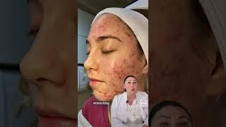 Learn about inflamed acne and the secret to treating it… an Acne Expert