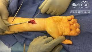 Tendon Laceration