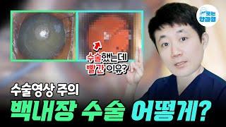  백내장 수술 어떻게 한다고? #백내장 #백내장수술