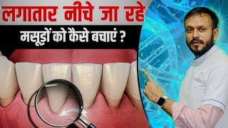 नीचे जा रहे मसूड़ो का घरेलू इलाज | Best Home Remedies for Gum Recession Hindi