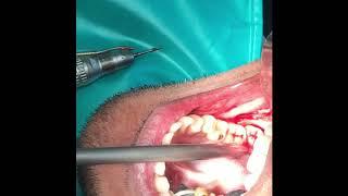 Dis Impaction - Wisdom tooth or third molar extraction