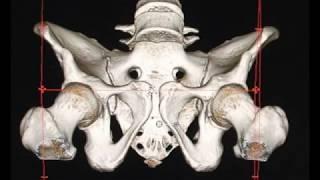 Internal Fixation of Posterior Pelvic Ring Injuries Using Iliosacral Screws...