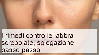 Labbra screpolate: i rimedi naturali | Marie Claire