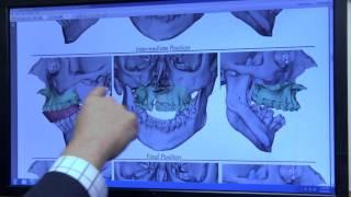 Virtual Surgery Planning