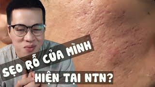 Khốn Khổ Vì Điều Trị Sẹo Rỗ - Giải Đáp Tất Cả Thắc Mắc Của Tất Cả Các Bạn