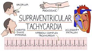 Understanding Supraventricular Tachycardia (SVT)