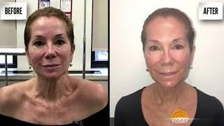 Kathie Lee Loves the Aerolase NeoSkin Rejuvenation Treatment