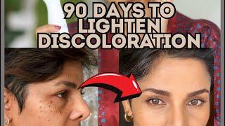 Creams couldn’t change my skin discoloration. Try this 90 day challenge with this beauty device