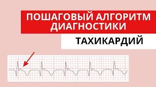 Как отличать тахикардии друг от друга? Алгоритм. Разбор ЭКГ.