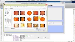 Matlab Project for Diabetic Retinopathy Detection Using Neural Network || IEEE Based Project