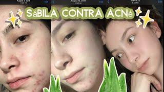 COMO CURAR EL ACNÉ  | SABILA PARA EL ACNE  | Diana DLH