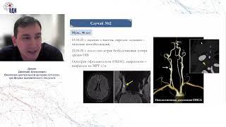 Окклюзия центральной артерии сетчатки, как форма ишемического инсульта. к.м.н. Демин Д.А.