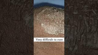 Fungal infection  #skincare #fungalinfection #tinea #eczema