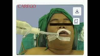 ENDOTRACHEAL INTUBATION