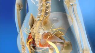 Sacral Neuromodulation | MOA Animation