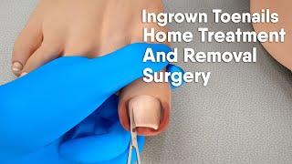 Ingrown toenail Home treatment and removal surgery|3d animation