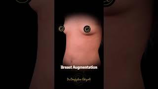 Amazing Breast Augmentation Results