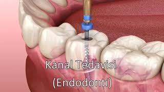 Kanal Tedavisi | Endodonti