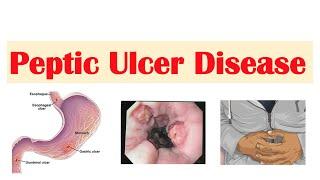 Peptic Ulcer Disease (Gastric vs. Duodenal Ulcers) | Causes,  Symptoms, Diagnosis, Treatment