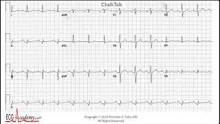 ECG 12-Lead Analysis – Advanced ChalkTalk #578