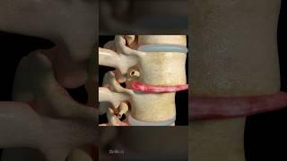 Intervertebral Disc Replacement: 3D Animation