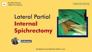 Lateral Partial Internal Spichrectomy || Dr. Vikas Gupta