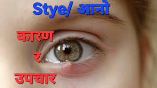 Stye/  आनो(aano) , कारण तथा घरेलु उपचार !