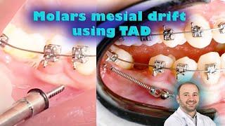 Dental implant or spaces closure by braces? using #tads (mini-implant) for molar mesial drifting