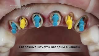 Восстановление культевыми вкладками шести передних зубов. Карнеев Андрей - врач стоматолог ортопед.
