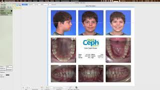 Quick Ceph Studio - Customize Gallery to adjust Maxilla and Mandible