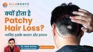 Patchy Hair Loss or Alopecia Areata क्यों होता है? जानिये इसके कारण और इलाज  | Dr Alok Sahoo